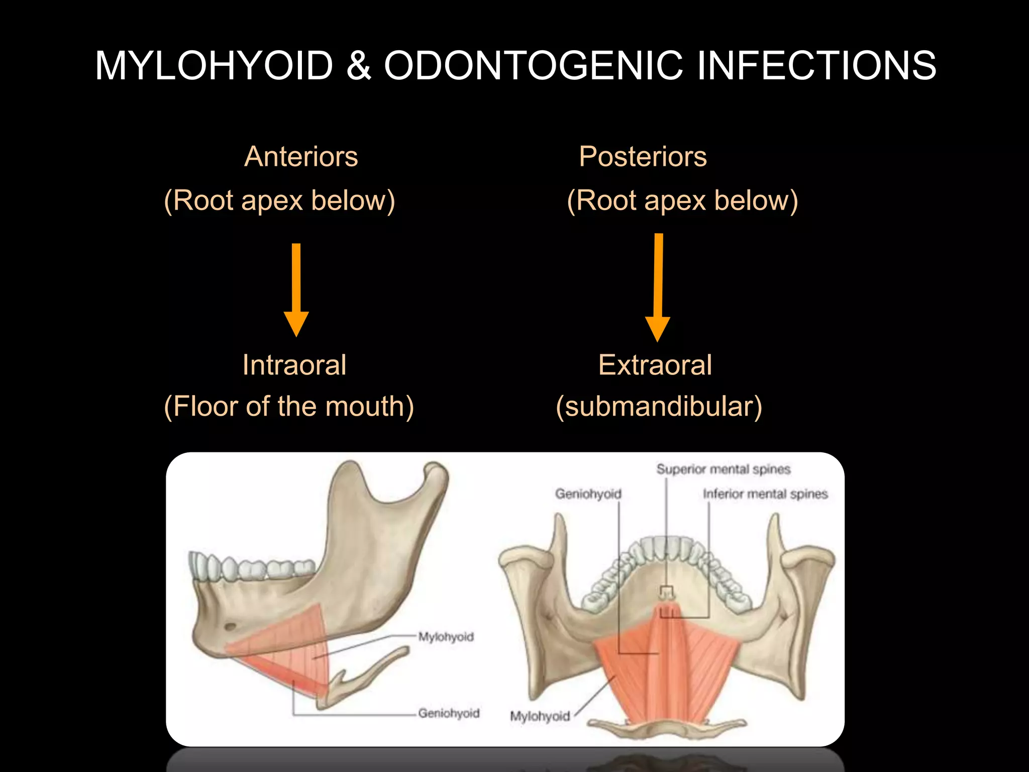 MYLOHYOID & ODONTOGENIC INFECTIONS 
Anteriors Posteriors 
(Root apex below) (Root apex below) 
Intraoral Extraoral 
(Floor of the mouth) (submandibular) 
 