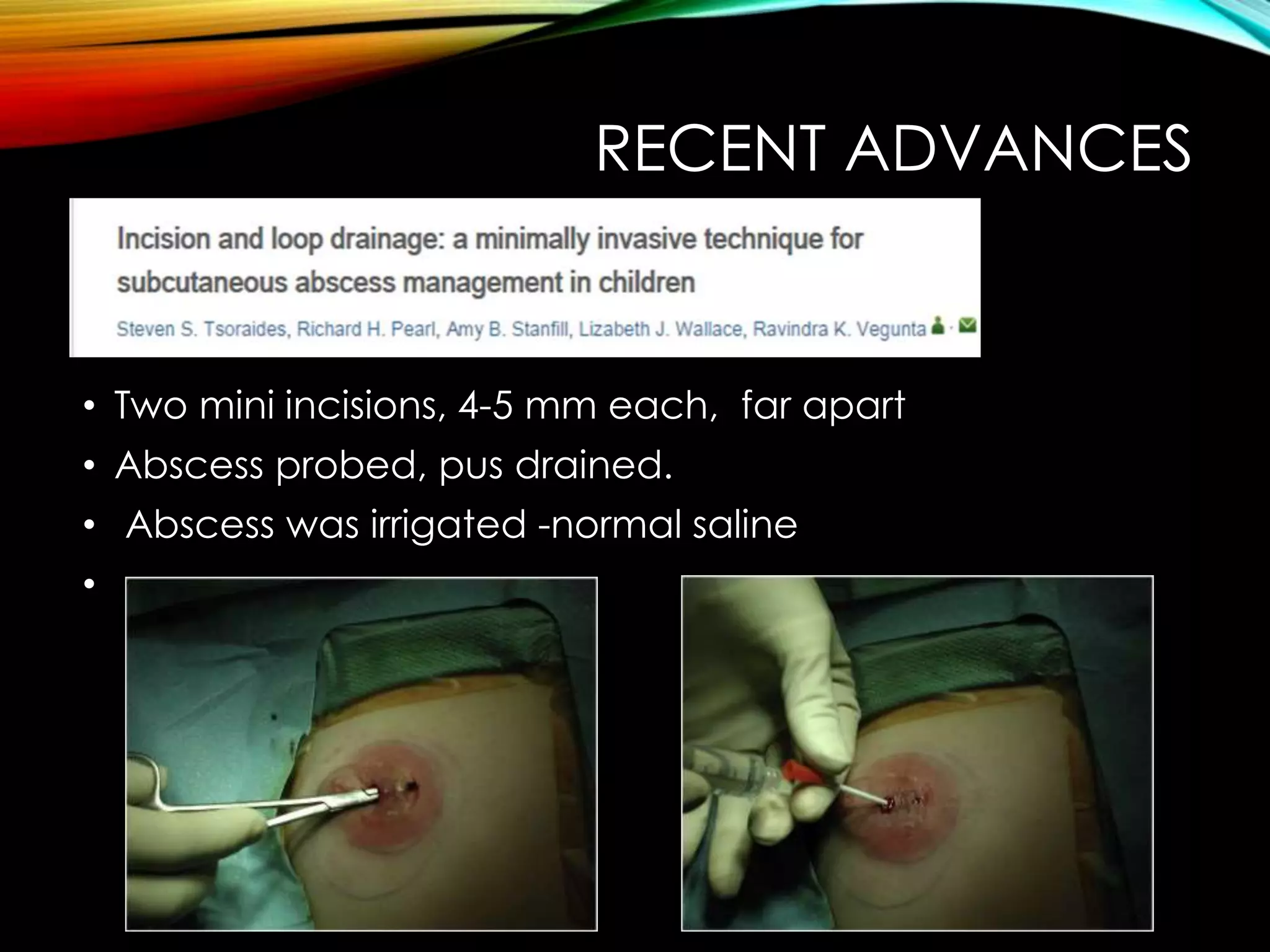 RECENT ADVANCES 
• Two mini incisions, 4-5 mm each, far apart 
• Abscess probed, pus drained. 
• Abscess was irrigated -normal saline 
• 
 