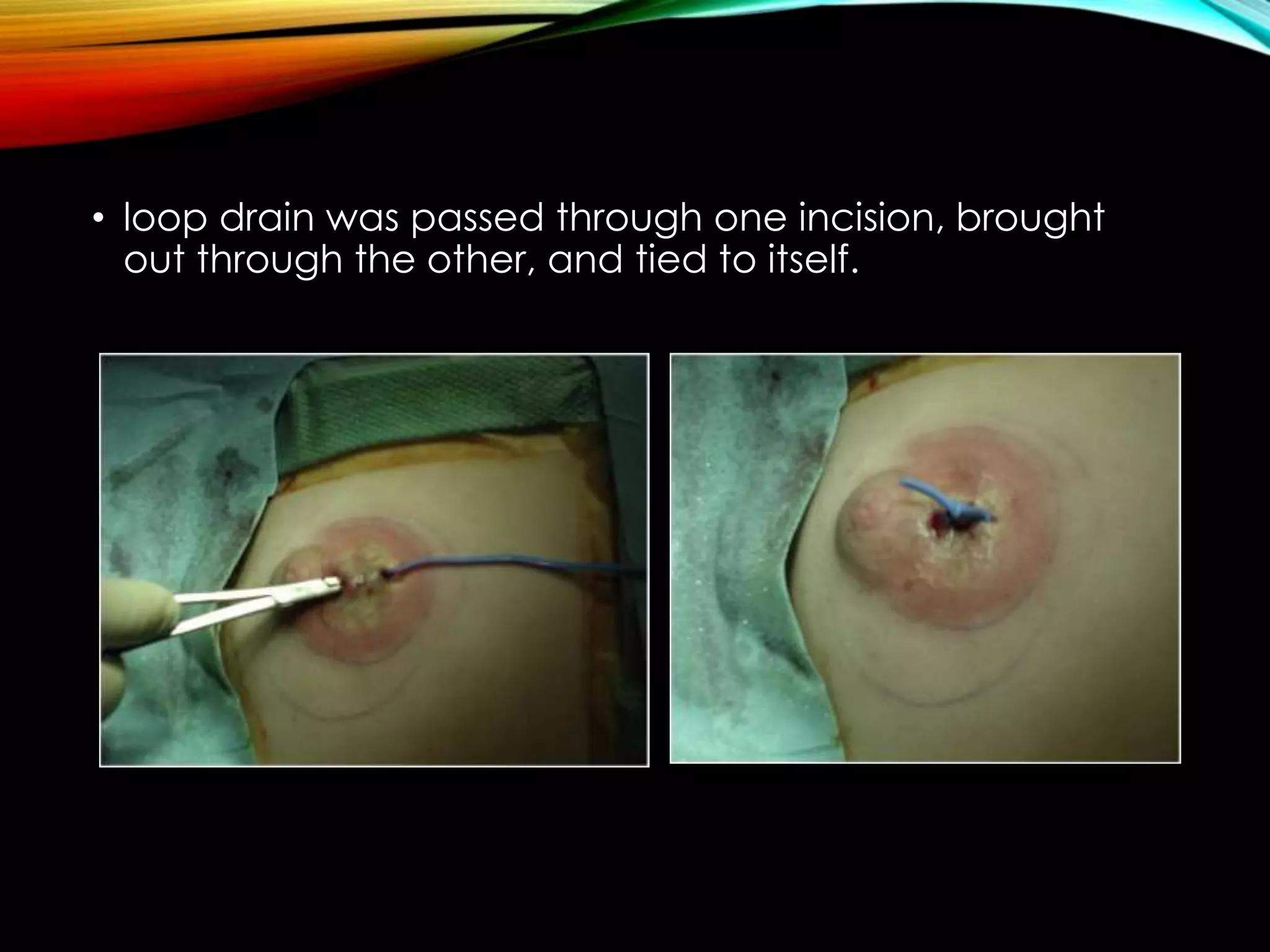 • loop drain was passed through one incision, brought 
out through the other, and tied to itself. 
 