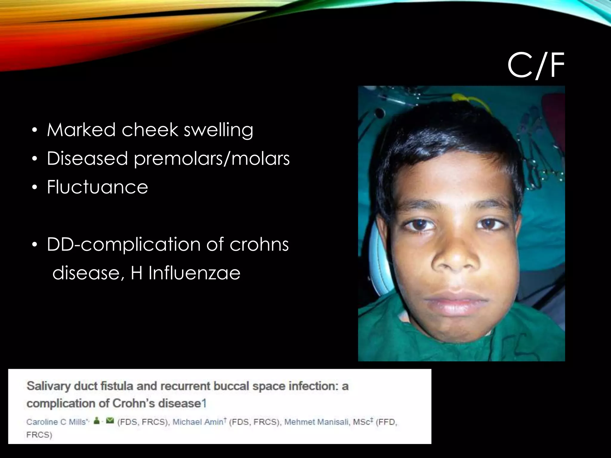 C/F 
• Marked cheek swelling 
• Diseased premolars/molars 
• Fluctuance 
• DD-complication of crohns 
disease, H Influenzae 
 