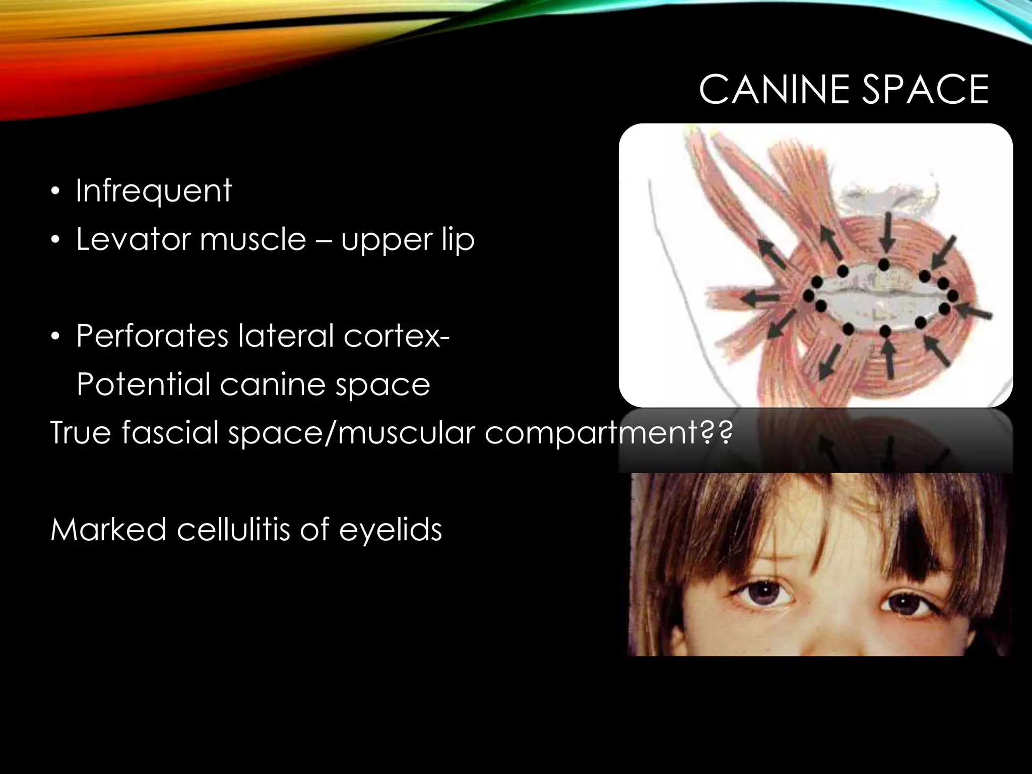 CANINE SPACE 
• Infrequent 
• Levator muscle – upper lip 
• Perforates lateral cortex- 
Potential canine space 
True fascial space/muscular compartment?? 
Marked cellulitis of eyelids 
 