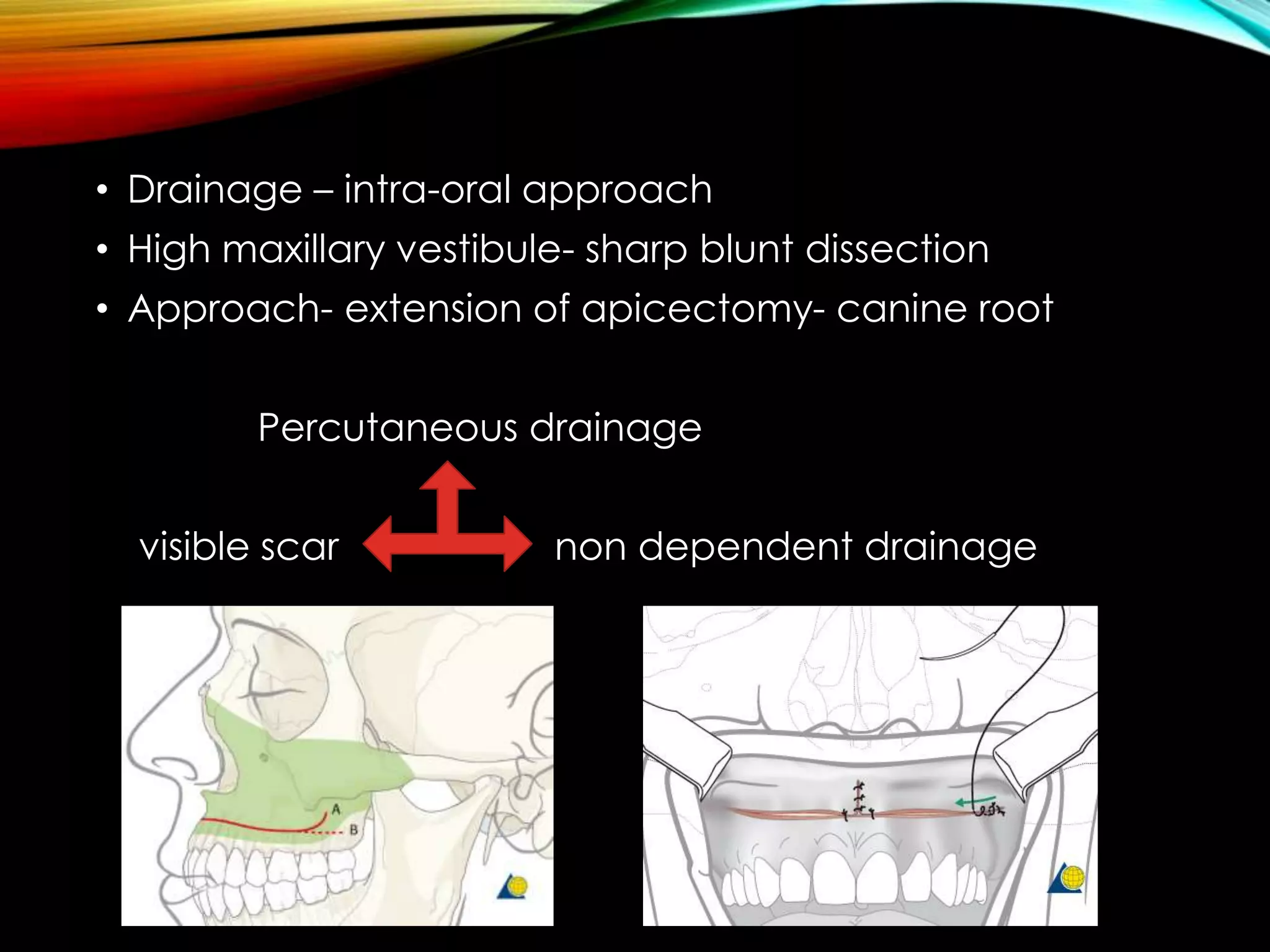 • Drainage – intra-oral approach 
• High maxillary vestibule- sharp blunt dissection 
• Approach- extension of apicectomy- canine root 
Percutaneous drainage 
visible scar non dependent drainage 
 