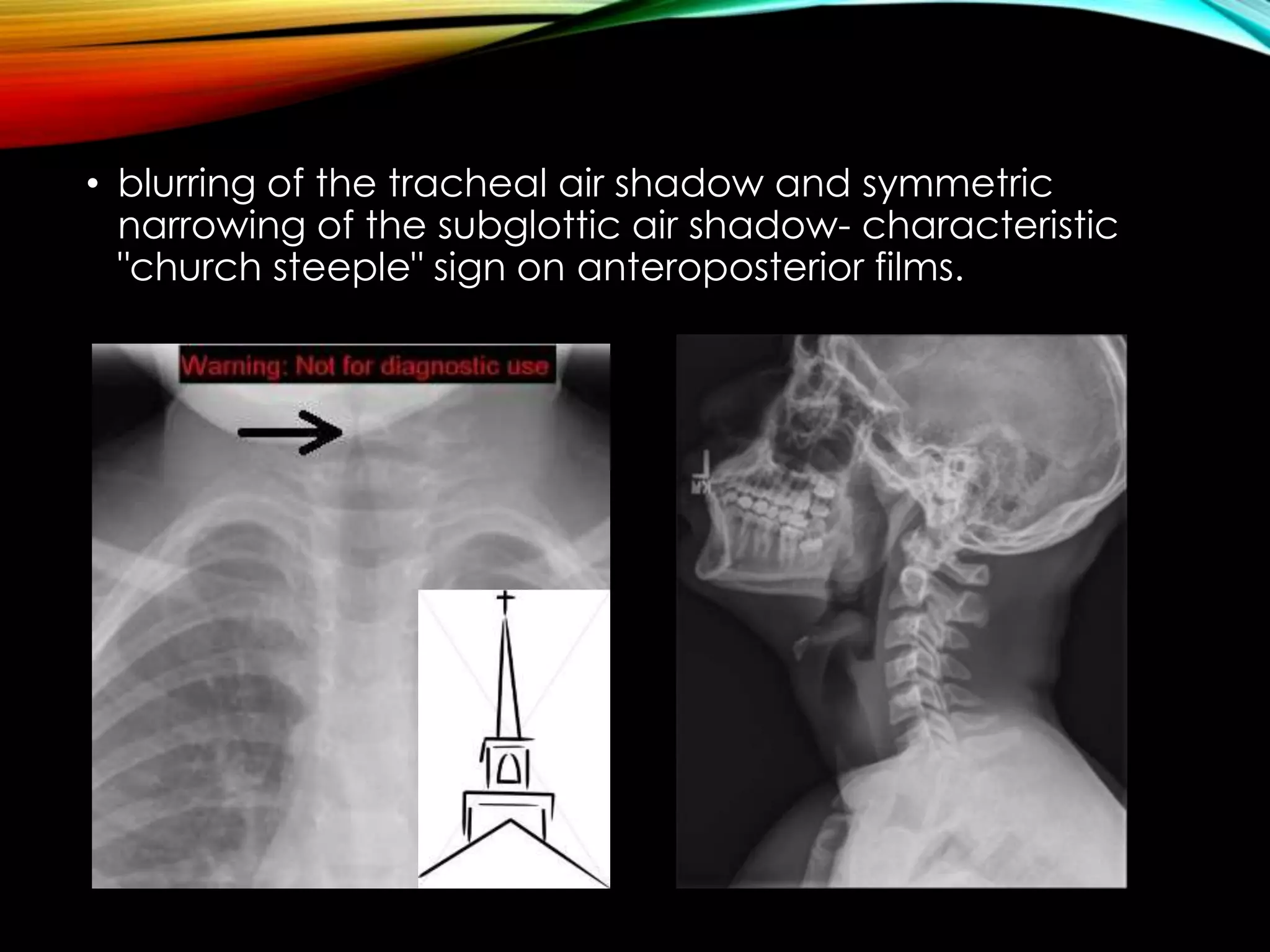 • blurring of the tracheal air shadow and symmetric 
narrowing of the subglottic air shadow- characteristic 
"church steeple" sign on anteroposterior films. 
 