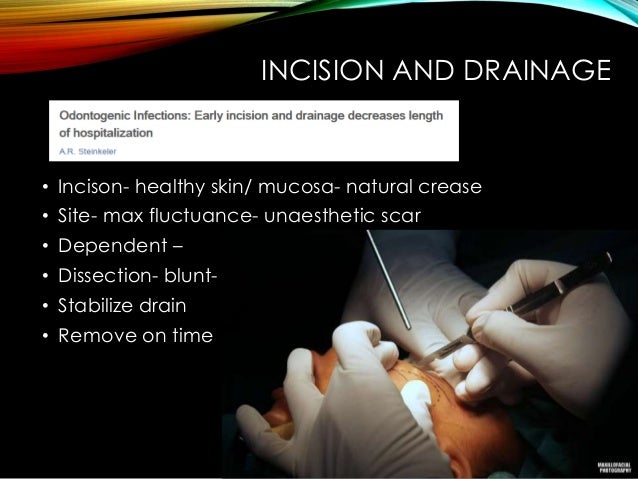 Draining Incision Incision And Drainage Dentistry And Medicine: Pterygomandibular