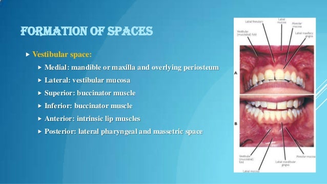 Facial spaces of periodontal interest.