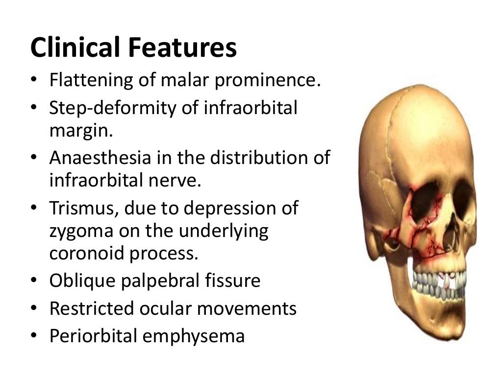 Facial trauma