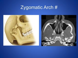 Zygomatic Arch #
 
