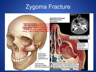 Zygoma Fracture
 