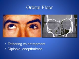 Orbital Floor
• Tethering vs entrapment
• Diplopia, enopthalmos
 