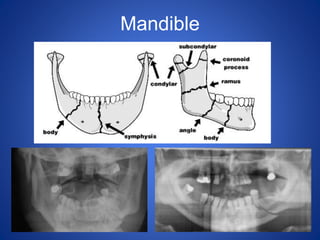Mandible
 