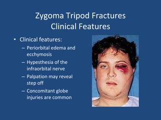 Zygoma Tripod Fractures Clinical Features Clinical features: Periorbital edema and ecchymosis Hypesthesia of the infraorbital nerve Palpation may reveal step off Concomitant globe injuries are common 