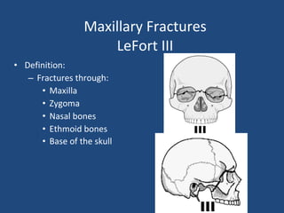 Maxillary Fractures LeFort III Definition: Fractures through: Maxilla Zygoma Nasal bones Ethmoid bones Base of the skull 