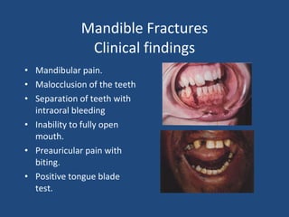 Mandible Fractures Clinical findings Mandibular pain. Malocclusion of the teeth Separation of teeth with intraoral bleeding Inability to fully open mouth. Preauricular pain with biting.  Positive tongue blade test. 