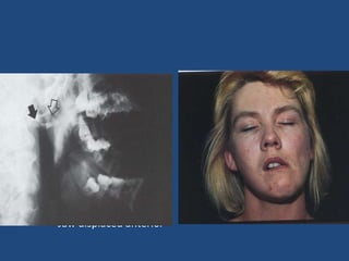 Clinical features: Inability to close mouth Pain Facial swelling Physical exam: Palpable depression Jaw will deviate away Jaw displaced anterior 