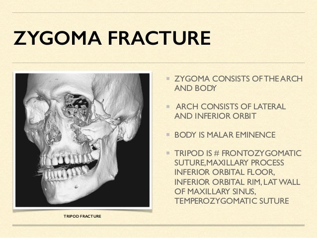 Facial Trauma Pdf