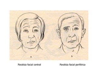 Paralisia facial central Paralisia facial periférica
 