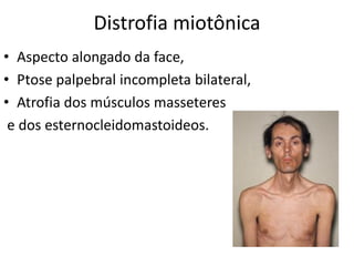Distrofia miotônica
• Aspecto alongado da face,
• Ptose palpebral incompleta bilateral,
• Atrofia dos músculos masseteres
e dos esternocleidomastoideos.
 