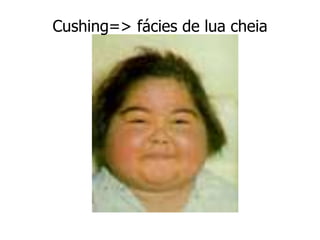 Cushing=> fácies de lua cheia
 