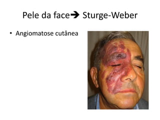 Pele da face Sturge-Weber
• Angiomatose cutânea
 