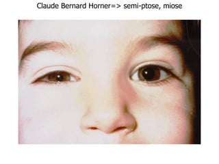 Claude Bernard Horner=> semi-ptose, miose
 