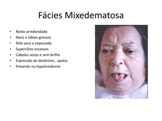 Fácies Mixedematosa
• Rosto arredondado
• Nariz e lábios grossos
• Pele seca e espessada
• Supercílios escassos
• Cabelos secos e sem brilho
• Expressão de desânimo , apatia
• Presente no hipotiroidismo
 