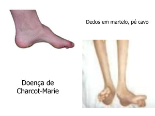 Doença de
Charcot-Marie
Dedos em martelo, pé cavo
 