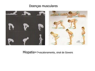 Miopatia=>escalonamento, sinal de Gowers
Doenças musculares
 