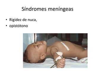 Síndromes meníngeas
• Rigidez de nuca,
• opistótono
 