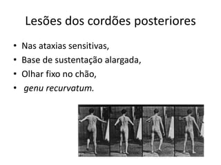 Lesões dos cordões posteriores
• Nas ataxias sensitivas,
• Base de sustentação alargada,
• Olhar fixo no chão,
• genu recurvatum.
 