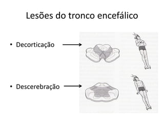 Lesões do tronco encefálico
• Decorticação
• Descerebração
 