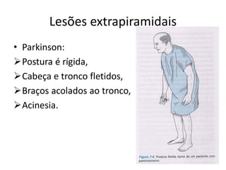 Lesões extrapiramidais
• Parkinson:
Postura é rígida,
Cabeça e tronco fletidos,
Braços acolados ao tronco,
Acinesia.
 