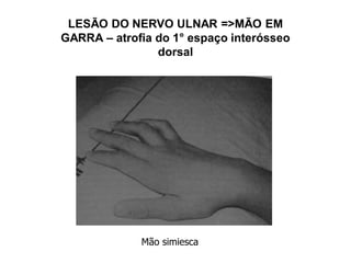 LESÃO DO NERVO ULNAR =>MÃO EM
GARRA – atrofia do 1° espaço interósseo
dorsal
Mão simiesca
 