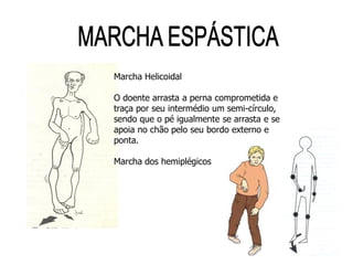 Marcha Helicoidal
O doente arrasta a perna comprometida e
traça por seu intermédio um semi-círculo,
sendo que o pé igualmente se arrasta e se
apoia no chão pelo seu bordo externo e
ponta.
Marcha dos hemiplégicos
 