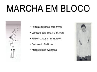 • Postura inclinada para frente
• Lentidão para iniciar a marcha
• Passos curtos e arrastados
• Doença de Parkinson
• Aterosclerose avançada
 