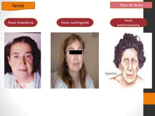 facies Tipos de facies
Facie mixedema Facie cushingoide
Facie
parkinsoniana
 
