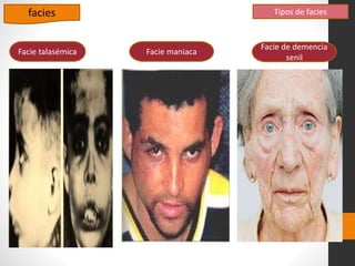 Tipos de faciesfacies
Facie maniacaFacie talasémica
Facie de demencia
senil
 
