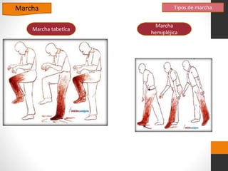 Marcha
Marcha tabetica
Marcha
hemipléjica
Tipos de marcha
 