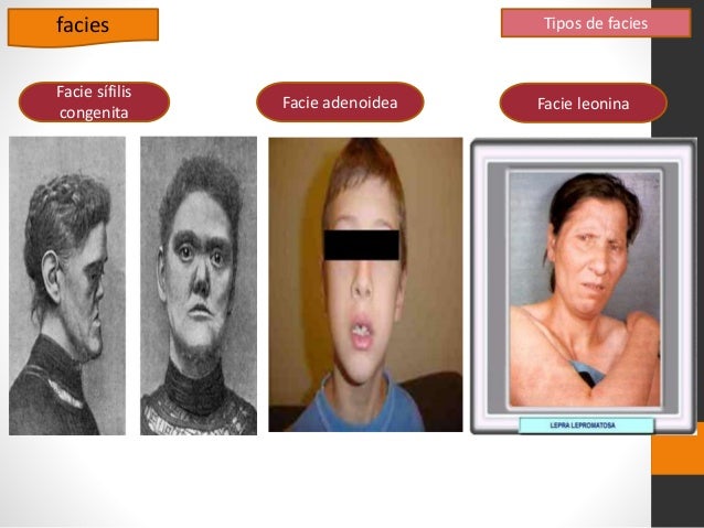 Facies, postura y marcha