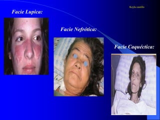 Facie Lupica:
Facie Nefrótica:
Facie Caquéctica:
Keyla castillo
 