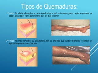 1er grado: Qx afecta solamente a la capa superficial de la piel, es la menos grave. La piel se enrojece, se
seca y causa dolor. Por lo general tarda de 5 a 6 días en sanar.
Tipos de Quemaduras:
2do grado: Qx más profundas. Su característica son las ampollas que pueden reventarse y secretar un
líquido transparente. Son dolorosas.
 