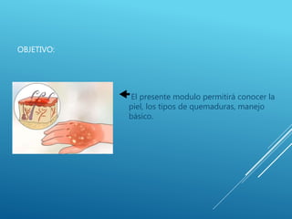 OBJETIVO:
El presente modulo permitirá conocer la
piel, los tipos de quemaduras, manejo
básico.
 