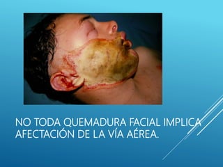 NO TODA QUEMADURA FACIAL IMPLICA
AFECTACIÓN DE LA VÍA AÉREA.
 
