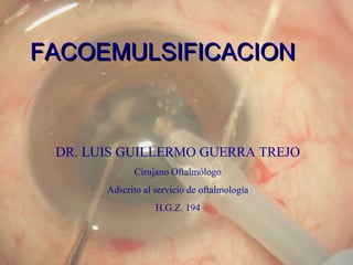 FACOEMULSIFICACIONFACOEMULSIFICACION
DR. LUIS GUILLERMO GUERRA TREJO
Cirujano Oftalmólogo
Adscrito al servicio de oftalmología
H.G.Z. 194
 