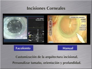 Incisiones Corneales Customización de la arquitectura incisional. Personalizar tamaño, orientación y profundidad. Facofemto Manual 
