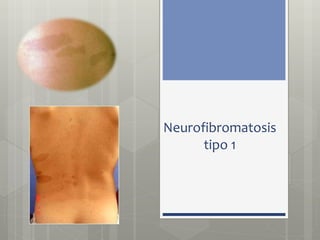 Neurofibromatosis 
tipo 1 
 