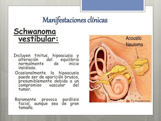 Manifestaciones clínicas 
Schwanoma 
vestibular: 
Incluyen tinitus, hipoacusia y 
alteración del equilibrio 
normalmente de inicio 
insidioso. 
Ocasionalmente la hipoacusia 
puede ser de aparición brusca, 
presumiblemente debida a un 
compromiso vascular del 
tumor. 
Raramente provoca parálisis 
facial, aunque sea de gran 
tamaño. 
 