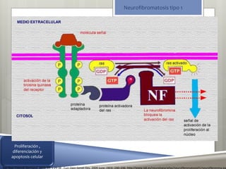 Neurofibromatosis tipo 1 
Proliferación , 
diferenciación y 
apoptosis celular 
Rev Asoc Colomb Dermatol. 2012; 20: 1,29-38 . Curr Opin Genet Dev. 2009 June; 19(3): 230–236. http://www.iqb.es/neurologia/atlas/neurofibromatosis01/neurofibromina.jpg 
 