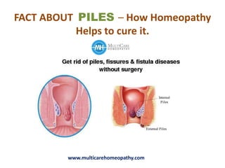 FACT ABOUT PILES – How Homeopathy
Helps to cure it.
www.multicarehomeopathy.com
 