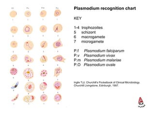 P. falciparum
• trophozoite: accolé form, multiple per RBC,
double chromatin dots, Maurer’s dots, crenated
RBC, high % RBC...