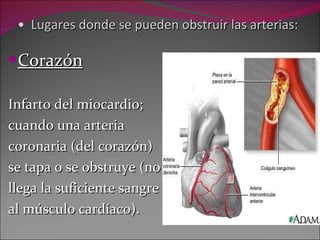 Lugares donde se pueden obstruir las arterias: Corazón Infarto del miocardio; cuando una arteria  coronaria (del corazón)  se tapa o se obstruye (no  llega la suficiente sangre  al músculo cardíaco). 